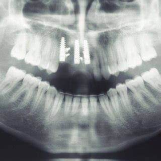 a & 3b: Subepithelial connective tissue graft procedure. (a) Donor ...