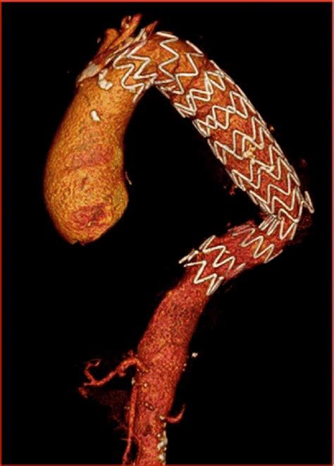 Postoperative CT scan showing correctly positioned endograft. | Download Scientific Diagram