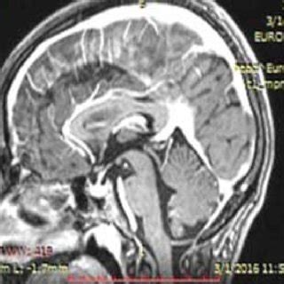 MRI: Idiopathic Intracranial Hypertension. | Download Scientific Diagram