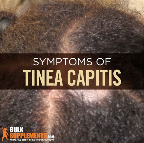 Tinea Capitis (Ringworm of the Scalp): Causes, Symptoms & Treatment