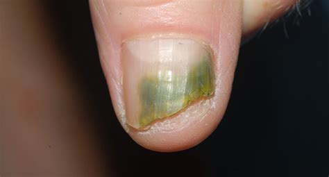Nail Fungus (Onychomycosis) - Laser Clinic Galway