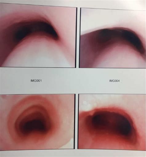 ISMICS - Circumflex Aorta And The 'Uncrossing' Operation