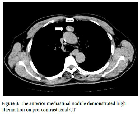 Ectopic Thyroid: An Unusual Cause of Anterior Mediastinal Mass | SciTechnol