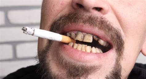 How To Remove Stains From Teeth Caused By Smoking: With Dental Procedures