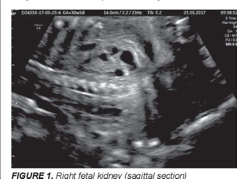 [PDF] POTTER SYNDROME, A RARE ENTITY WITH HIGH RECURRENCE RISK IN WOMEN ...