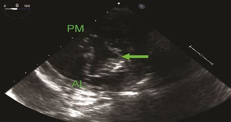 Cleft Posterior Mitral Valve Leaflet: Identification Using T ...