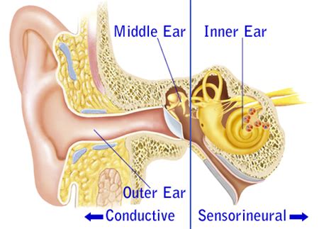 Sensorineural Hearing Loss