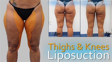 Lipo 360 Legs | Thigh & Knee Liposuction | Lipedema Surgery | Expert Dr ...