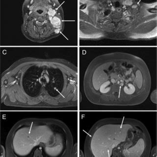 Initial radiologic staging confirming lymphoma Ann Arbor stage IV. (A)... | Download Scientific ...