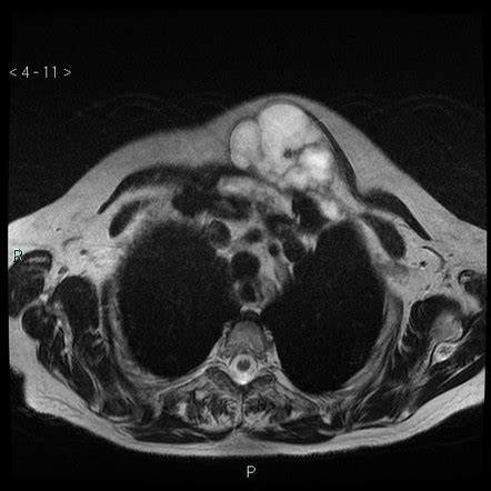 Low-grade chondrosarcoma: sternum | Radiology Case | Radiopaedia.org