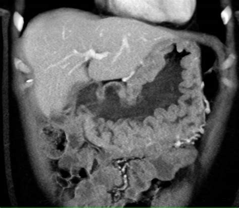 Zollinger-Ellison Syndrome with Enhancing Mass in the Mesentery and ...