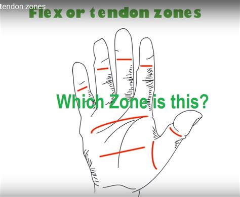 Flexor Tendon Zones of the Hand — OrthopaedicPrinciples.com