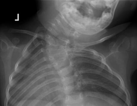 Cervical Scoliosis: Spinal Curvature in the Neck