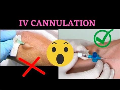 IV Cannulation Technique | Procedure |Intravenous(IV) Cannula Insertion - YouTube