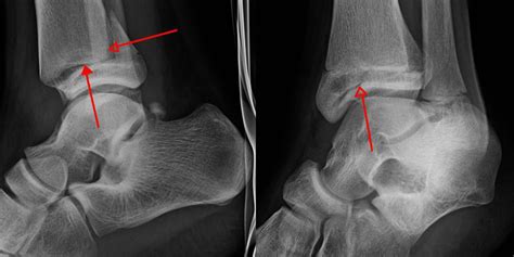 Avulsion Fracture Diagnosis and Treatment | Baron Active