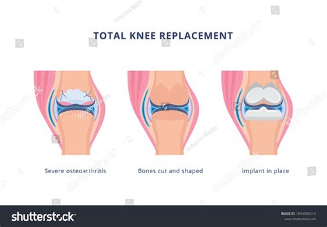 Total Knee Replacement Surgery Procedure Explanation Stock Vector ...