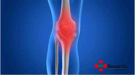 Knee Replacement Surgery: Know the Complications