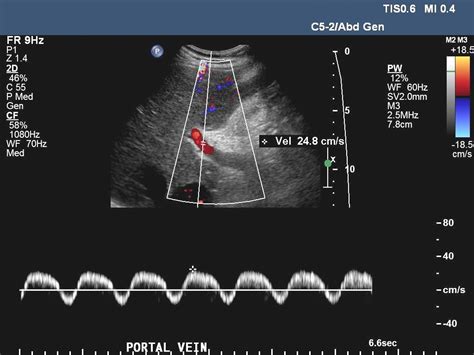 pulsatile portal vein flow reversal