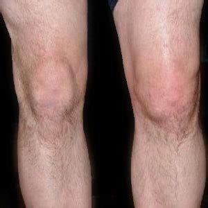 Water on the Knee (Knee Effusion) - Pro Knee Pain Relief