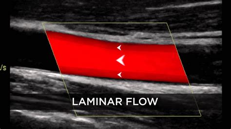 Introduction to Doppler Ultrasound - YouTube