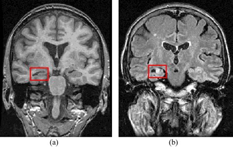 Mesial temporal sclerosis lesion (a) T1-weighted MRI and (b) FLAIR MRI... | Download Scientific ...