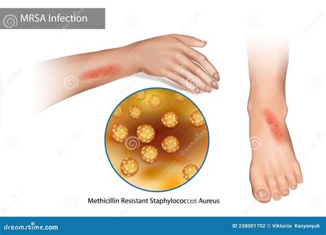 MRSA Superbug Infection. Methicillin Resistant Staphylococcus Aureus Stock Vector - Illustration ...