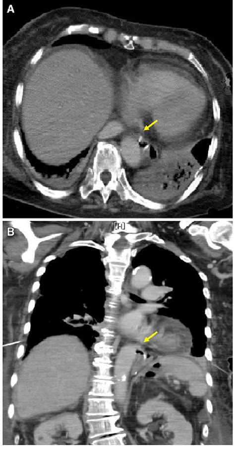 Contrast-enhanced computed tomography taken 4 days after the first ...