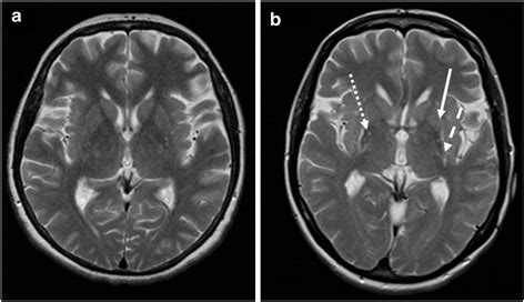 Structural MRI in Idiopathic Parkinson Disease and Parkinsonism ...