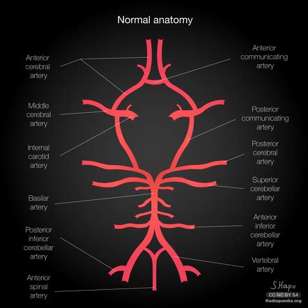 Posterior inferior cerebellar artery | Radiology Reference Article ...