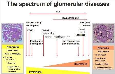 Glomerular Diseases Causes Clinical Presentation Symptoms Etiology ...