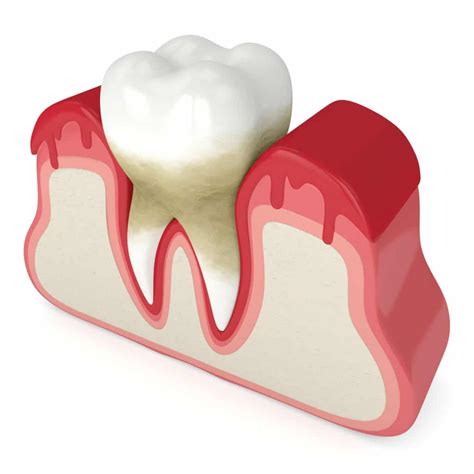 5 Causes of Periodontal Disease - Austin Laser Dentist