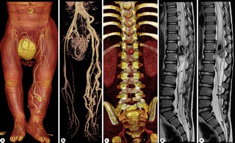 Parkes-Weber Syndrome with Spinal Arteriovenous Fistula in Childhood - ICPR