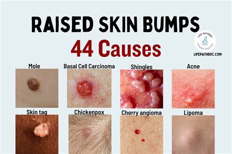 Raised Skin Bumps: 44 Causes, Pictures and Treatment