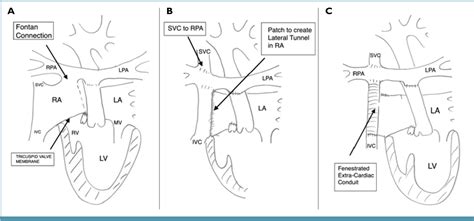 Figure 2 from Management of the Fontan circulation in the adult patient ...