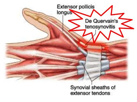 Dequervain's Tenosynovitis - South Florida Hand Surgery