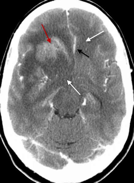 Learning Radiology - Glioblastoma Multiforme, GBM