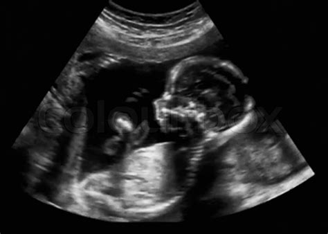 Obstetric Ultrasonography Ultrasound ... | Stock image | Colourbox