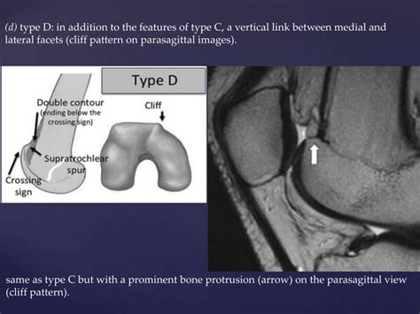 Patello femoral joint - MRI | PPT