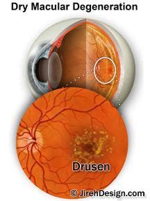 Drusen | small deposits in the retina from macular degeneration