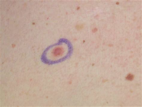 Amelanotic Melanoma: Symptoms, Causes, Treatment - Dr. Maral Skelsey