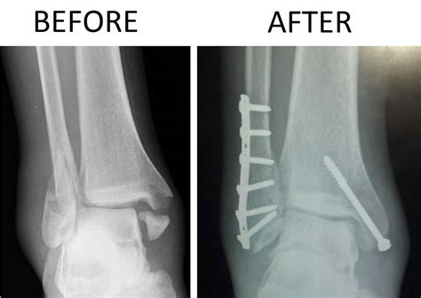 Bimalleolar fracture causes, symptoms,diagnosis, treatment & recovery