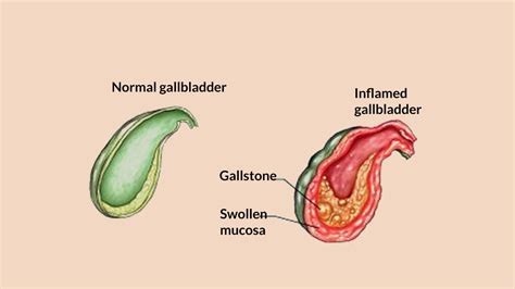 Cholecystitis – Diagnosis, Treatment and Prevention – NutritionFact.in