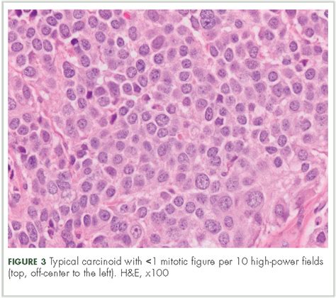 Clinical presentation, diagnosis, and management of typical and atypical bronchopulmonary ...