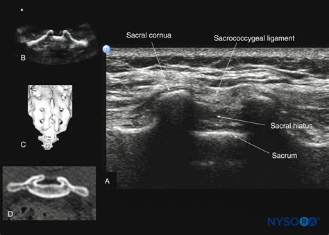 Spinal Sonography and Applications of Ultrasound for Central Neuraxial Blocks - NYSORA