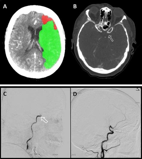 CT Brain Perfusion, CTA, Brain Angiography. A: A CT perfusion algorithm... | Download Scientific ...