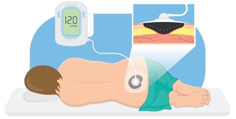 Data Grow for Negative Pressure Wound Therapy With Instillation, Dwell Time