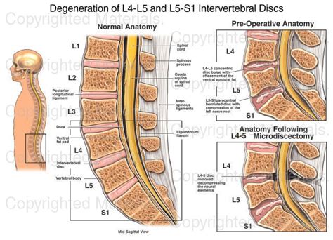 Degeneration of L4-L5 and L5-S1 Intervertebral Discs Human Body Lesson Plans, Physician ...