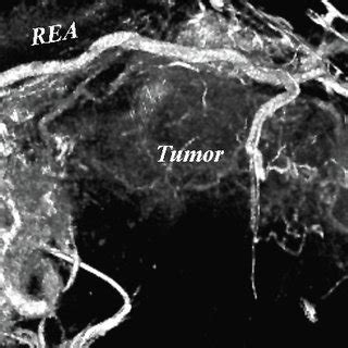 3-D reconstructed angiography of the gastroepiploic artery. A major ...