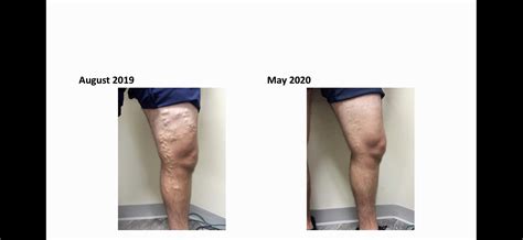 Vein Testimonials | Chesapeake Vein Center & Medspa