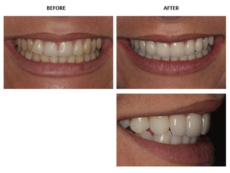 Inman Aligner before and after pictures - Inman Aligner